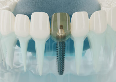 Implantologie dental biberach an der riss